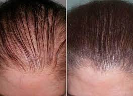 Grow Hair® - Escova estimuladora de crescimento capilar + Brinde
